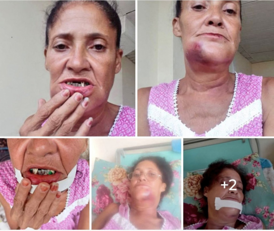 Brutal agresión en El Cotorro: Anciana con fractura de mandíbula y el agresor sigue libre, ¿hasta cuándo la impunidad?